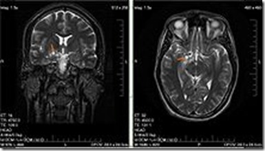 220px-MRI_glioma_28_yr_old_male